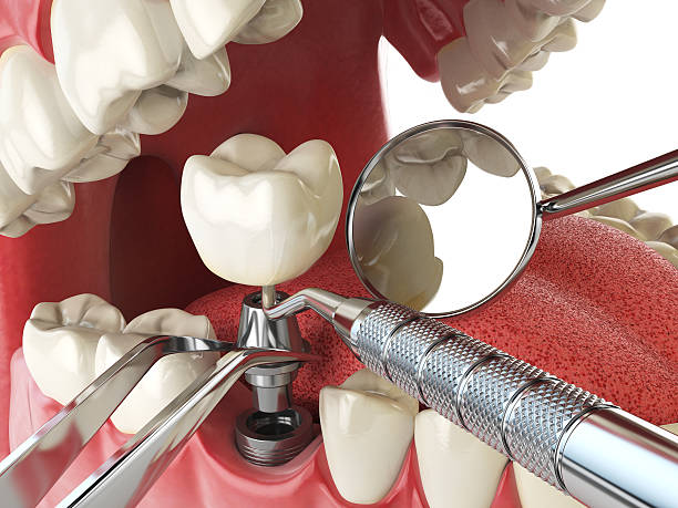 Best Emergency Tooth Extraction in Weedsport, NY